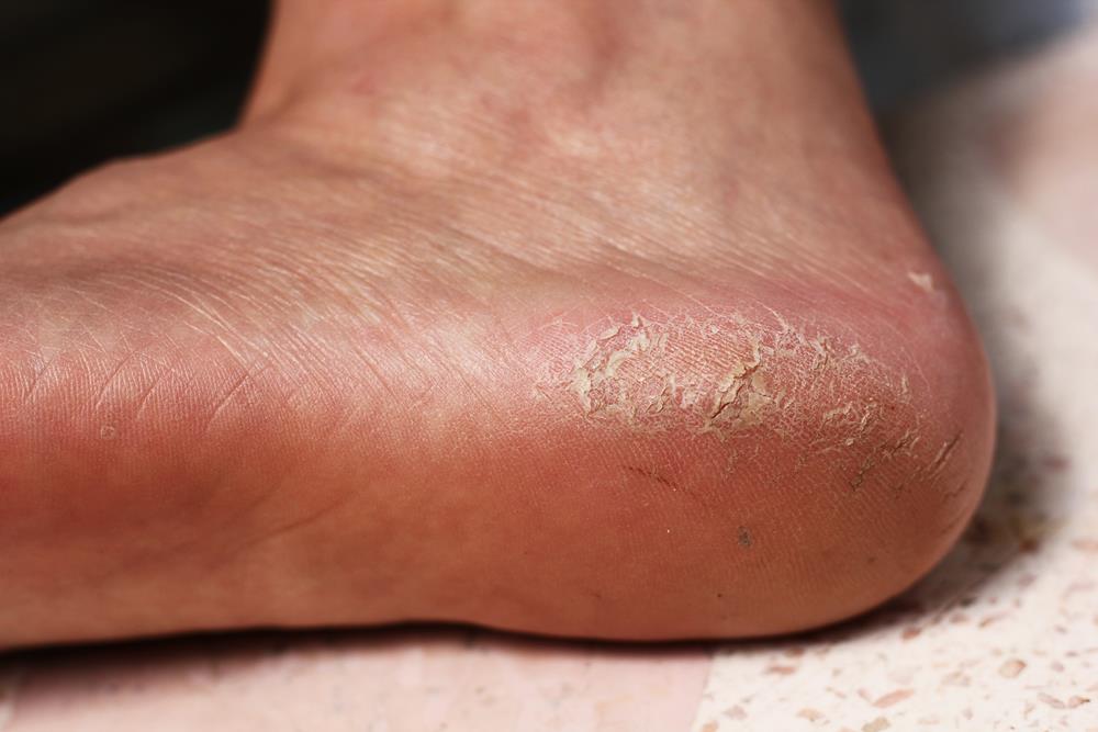 Calluses  <a href="kissimmee-office">Kissimmee Office</a>